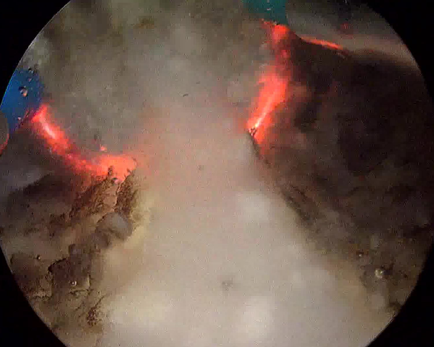 Endoscopic prostate surgery performed on a first human-like phantom